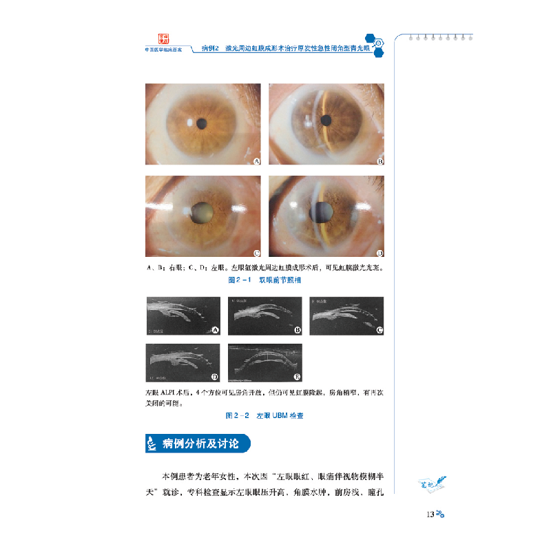 醉染图书梁远波青光眼疑难病例精解9787518992065高清大图