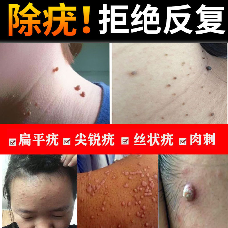 樱色须泡 膏 啫喱 优选好货 点祛疣必治扁平疣日本去疣灵病毒疣体去除神器药膏一抹灵正品外用 价格图片品牌报价 苏宁易购星之渡美妆个护专营店