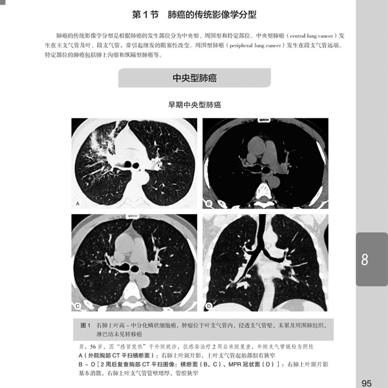 [醉染正版]肿瘤影像诊断图谱 第2版分享中国医学科学院肿瘤医院影像科多年宝贵的诊断与鉴别诊断经验周纯武赵心明主编影像医学