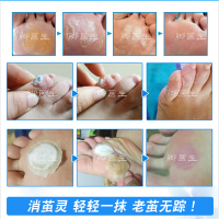 【买2发3盒】脚医生正品消茧灵去除脚底上老茧脚垫净厚茧胼胝角质死皮液非膏体祛除硬茧脚趾茧硬皮脚茧手茧茧子清成膜剂