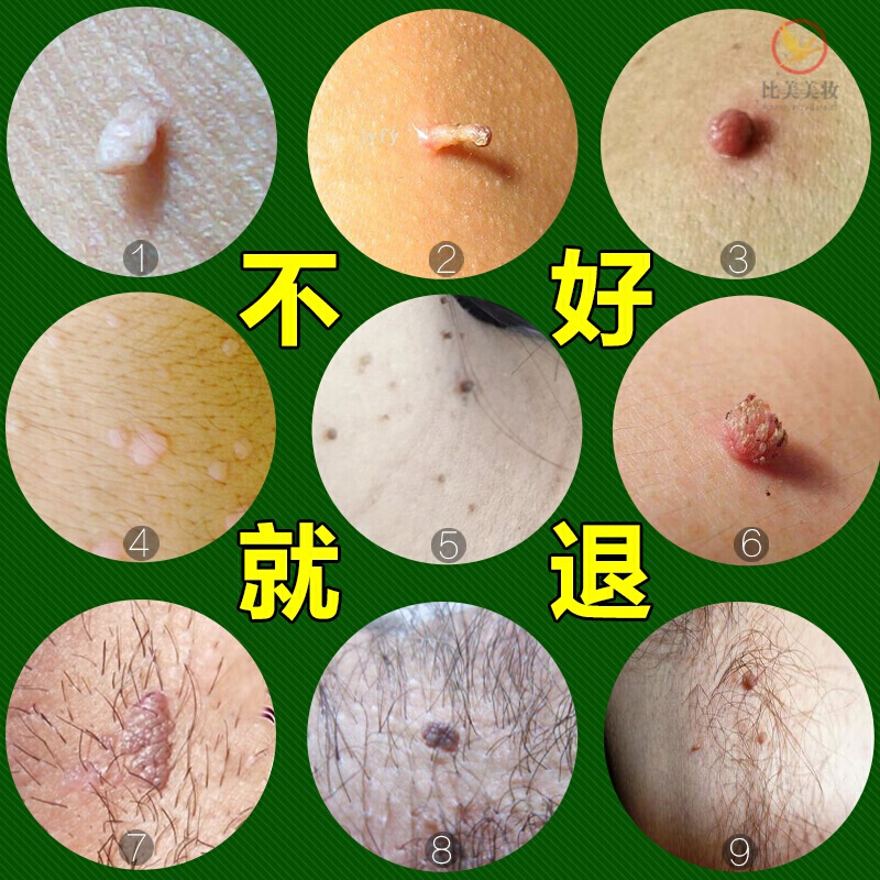 去除脖子小肉粒 克疣液笔去除肉刺瘊子克疣净手部脸部猴子足部扁平