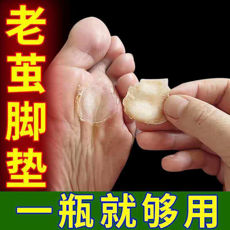 发一盒 柏敦鸡尤清鸡茧跖疣老茧膏脚垫肉刺鱼鳞痣瘊子鸡眼膏甲周疣肉粒