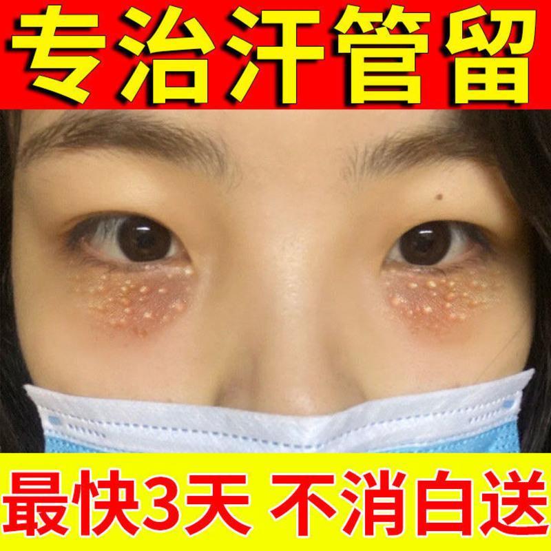 [不消白送]汗管留去除神器去脂肪粒汗管粒油脂粒祛眼部颗粒眼霜