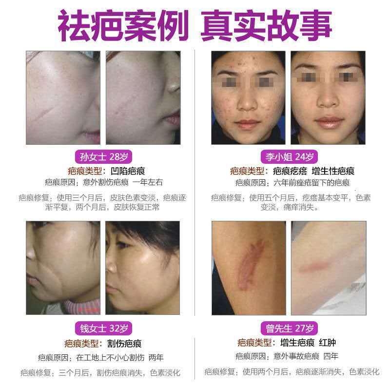 薰衣膏去疤霜修复膏去痘疤剖腹产疤去妊娠纹疤痕灵图片