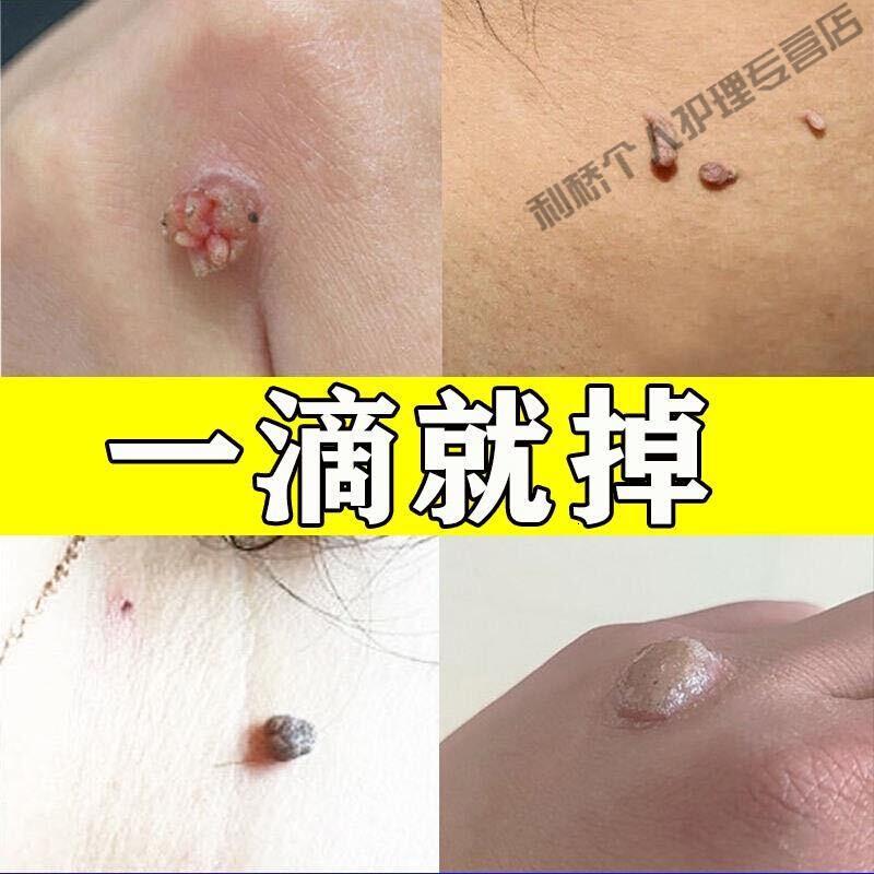 去除脖子小肉粒颈部赘皮赘草温和不留疤祛丝状尤腋下小猴子