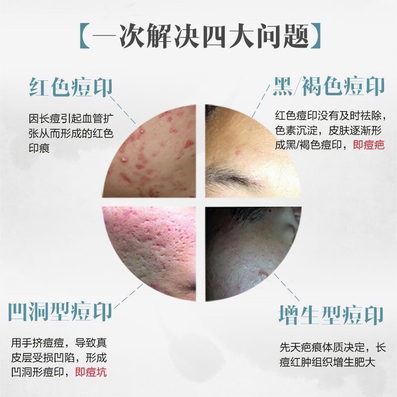 快速祛痘膏男女学生祛痘印产品去痘印修复痘坑青春痘去痘痘膏套装 (轻度)祛痘