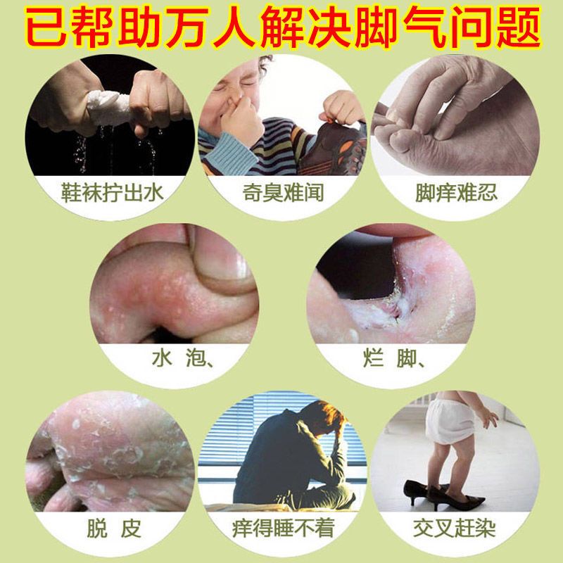 奇诗脚气膏脚气脚臭治烂脚丫脱皮水泡反复性真菌脚气1支装