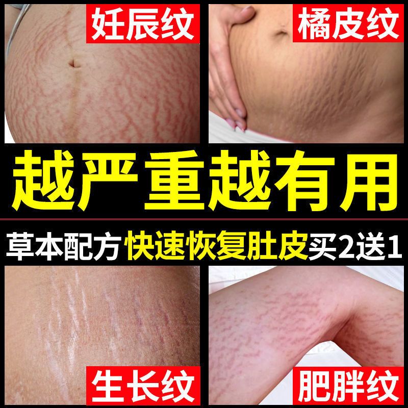 祛妊辰修复霜预防孕妇产后专用消除紧致淡化肥胖生长妊娠纹橄榄油