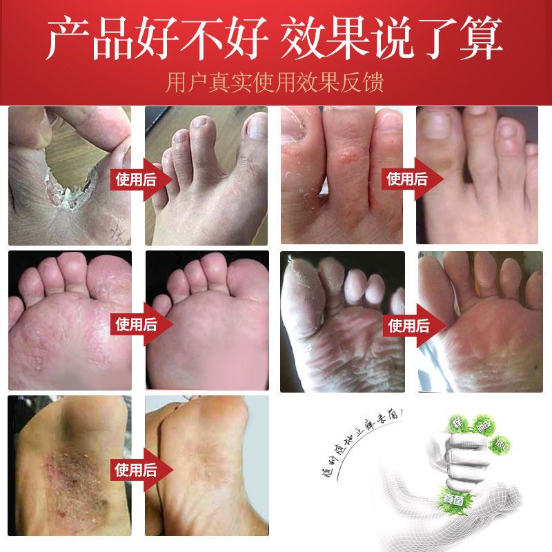 图书>期刊/杂志>男士>图书其它>去脚气脚臭脚痒脚气治疗脚气膏脱皮除