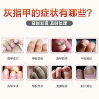 【苏宁正品】修正灰指甲抑菌液专外用指甲变白色板萎缩浑浊增厚脱落翘起脆易碎灰趾亮甲勾炎净康灵炎消的护理辉之间液 灰指甲专用