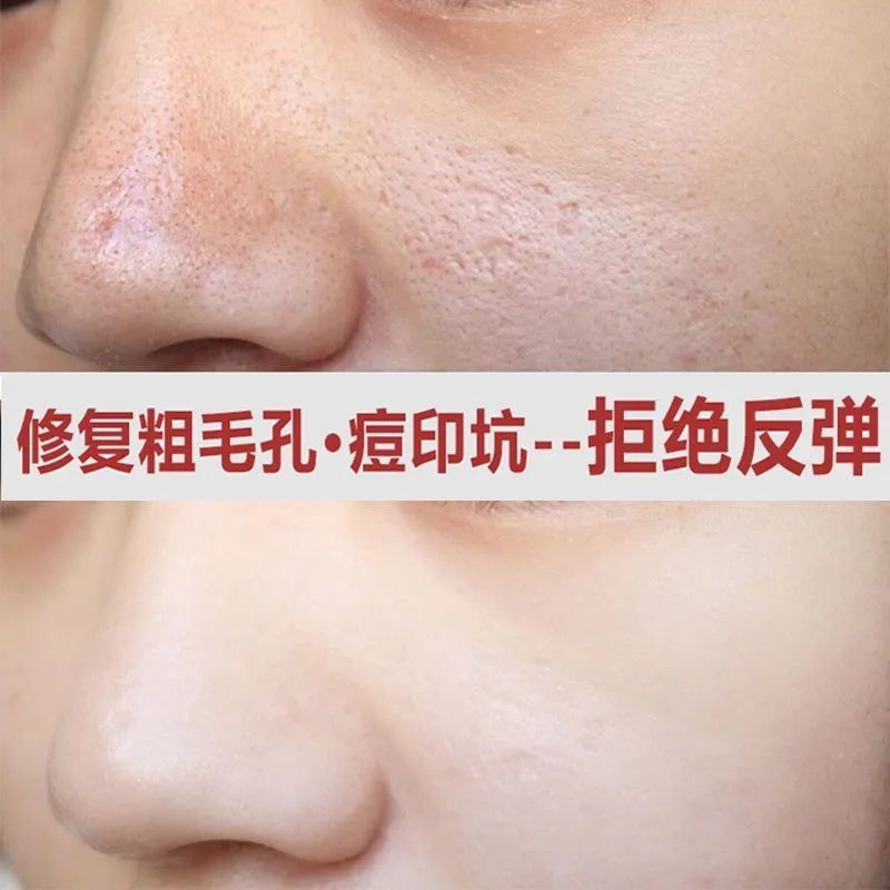 单瓶体验装 收缩毛孔去黑头去痘印去角质粉刺毛孔粗大修复精华液补水男女学生