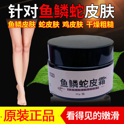 鸡皮肤去鱼鳞蛇皮肤干燥起皮脱皮全身体软膏乳膏买1送1