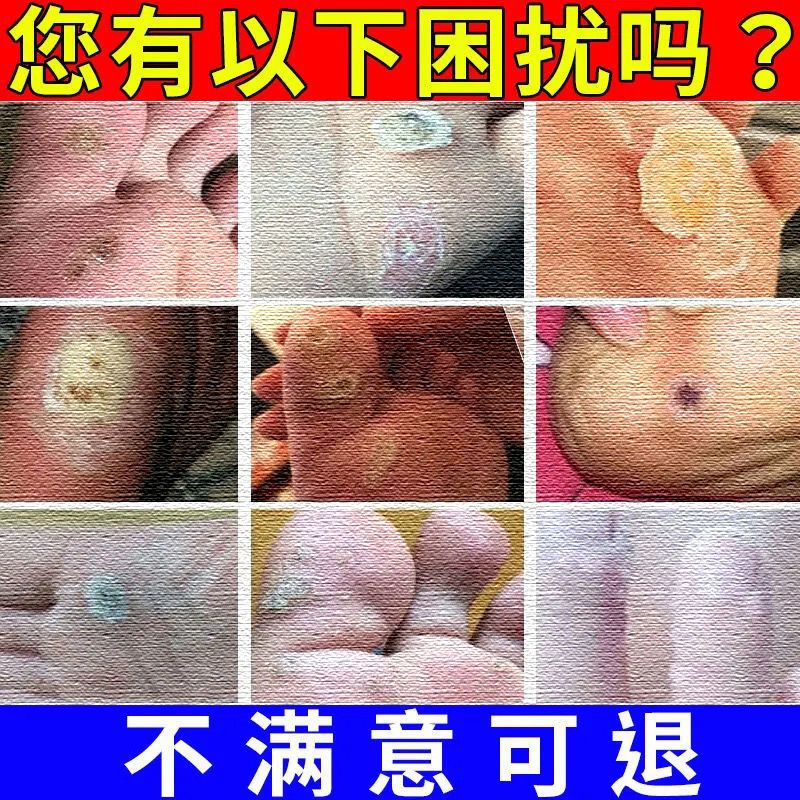 [无痛掉]鸡眼膏鸡眼贴去垠脚趾手指长鸡眼跖疣顽固反复鸡眼专用 鸡眼