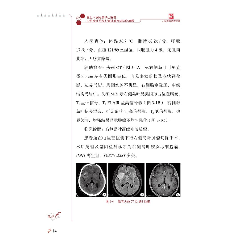 正版 复旦大学附属华山医院中枢神经系统肿瘤疑难疾病病例精解 毛高清大图