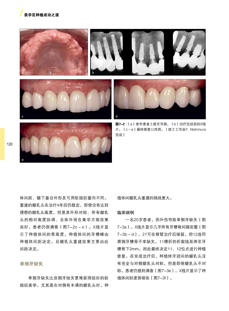 [醉染正版]美学区种植成功之道汤春波主编美学区种植的手术设计美学分析外科操作软硬组织增量二期手术方式辽宁科学技术出版社高清大图