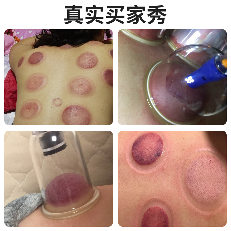 修正拓伦拔罐器家用套装真空抽气式祛湿驱寒美容院夏季加厚非玻璃火罐