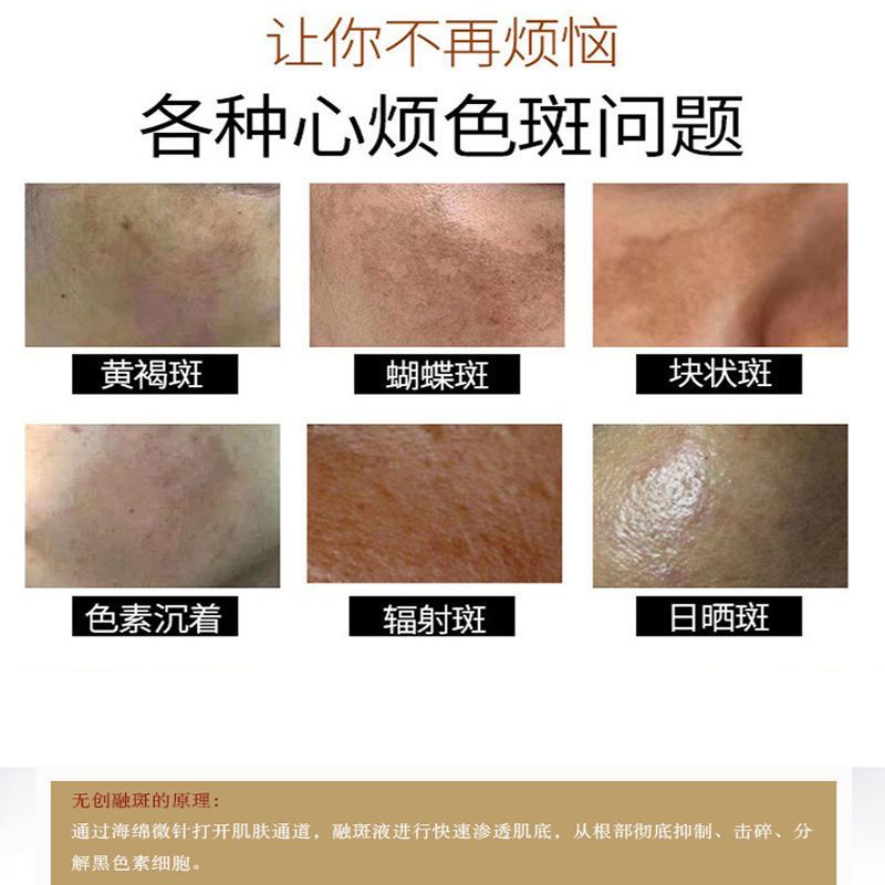 无创溶斑液去除真皮斑黄褐斑壬辰斑老人斑混合斑厂家批发不含仪器 无创溶斑液去除真皮斑黄褐斑壬辰斑老人斑混合斑厂家批发不含仪