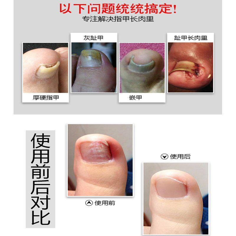 指甲钳甲沟炎专用指甲刀指甲剪鹰嘴甲沟钳修甲刀死皮工具修脚剪刀
