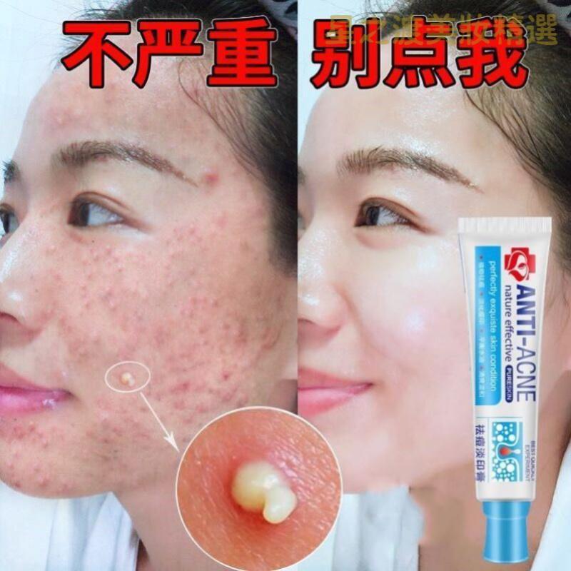 优选好货研春堂祛痘膏去痘坑痘印痘疤抖音同款祛青春痘学生亮肤淡印膏
