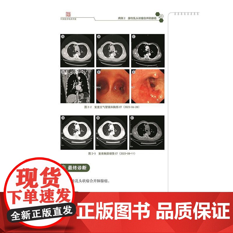 解放军总医院呼吸与危重症医学部疑难病例精解 赵卫国 王韧韬 刘慧莹 主编 黏液表皮样癌等 9787523519295科高清大图