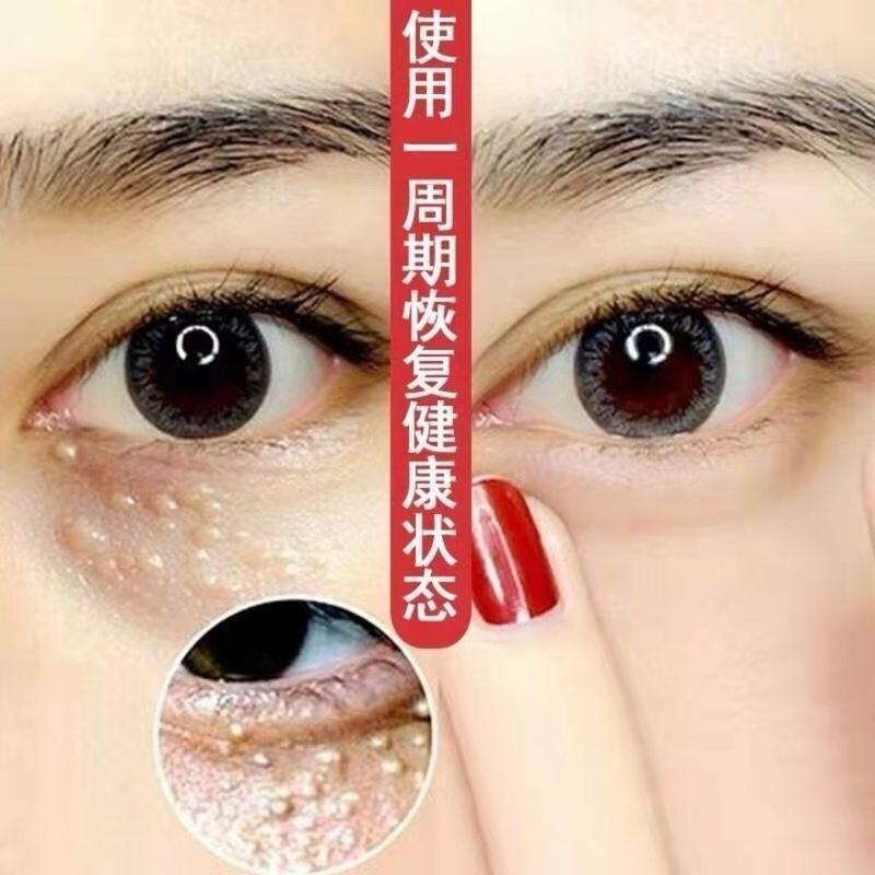 去眼部脂肪粒油脂粒汗管粒眼霜消除眼部脂肪粒去除神器 一盒装[优惠价