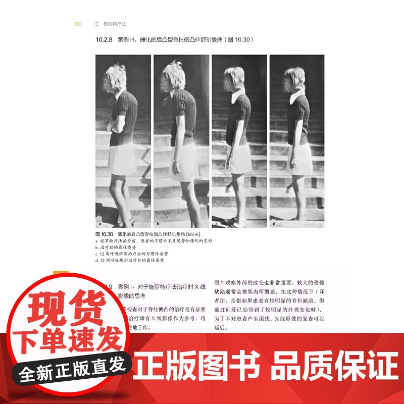 脊柱侧凸治疗方案 2册 如果我有脊柱侧凸+施罗特脊柱侧凸三维治疗第9版 非手术治疗 脊柱侧凸 北京科学技术高清大图