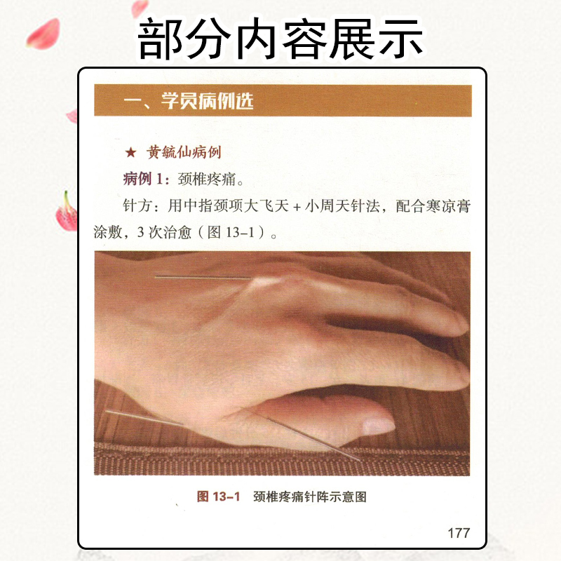 [正版]陈氏气道手针 陈元伦 主编 常见病特效针方 手针疗法概述 眼干涩及迎风流泪 止咳三针 中国科学技术出版社978
