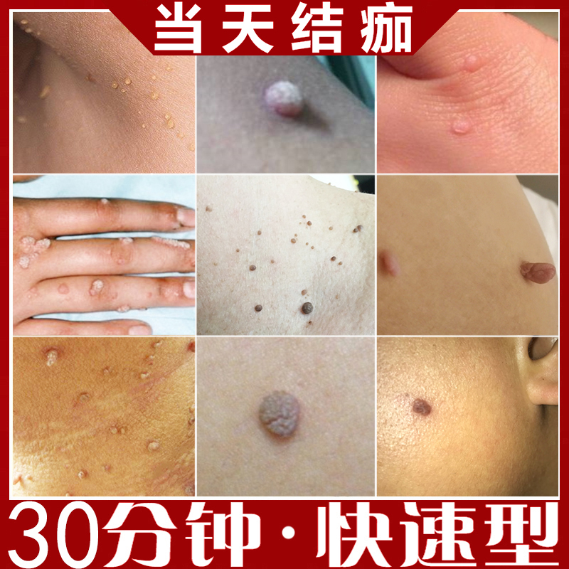 樱色须泡 膏 啫喱 优选好货 点祛疣必治扁平疣日本去疣灵病毒疣体去除神器专用药膏一抹灵正品 价格图片品牌报价 苏宁易购星之渡美妆个护专营店