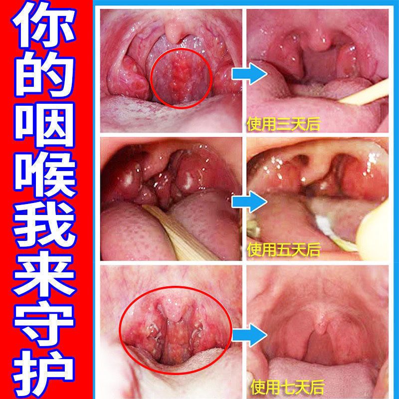 单盒体验装 咽炎急慢性咽喉干呕咳异物感肿痛滤泡增生有痰咳嗽贴