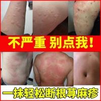 专用慢性寻荨麻疹外用断根的风团过敏皮肤瘙痒止痒日本膏