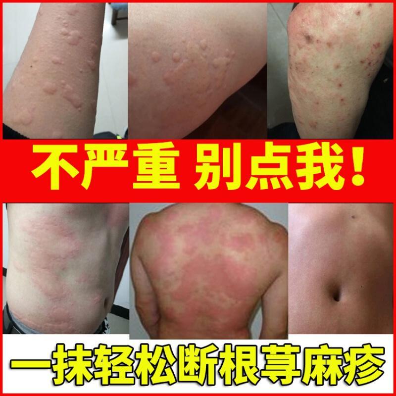 专用慢性寻荨麻疹外用断根的风团过敏皮肤瘙痒止痒日本膏