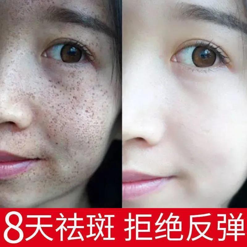 [美白祛斑]去痣神器白点痣笔激光祛斑笔无痕点斑脸部祛黑痣 1支[面部淡斑]祛斑笔新款