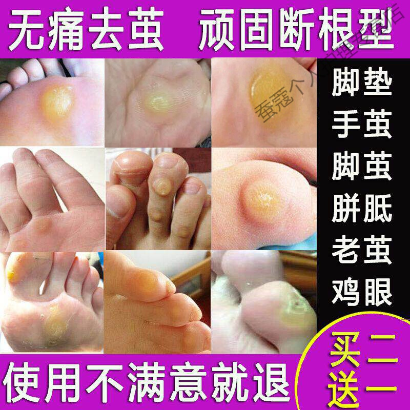 脚底老茧去除膏硬死皮软化剂脚茧子去除治脚垫的胼胝贴足部
