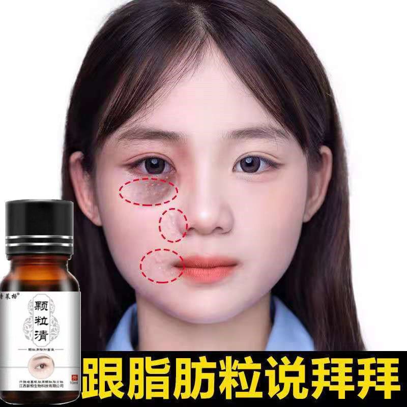 去脂肪粒汗管粒油脂粒神器眼霜祛除眼部黑眼圈脸部颗粒精华液男女 1瓶[送专业棉签]