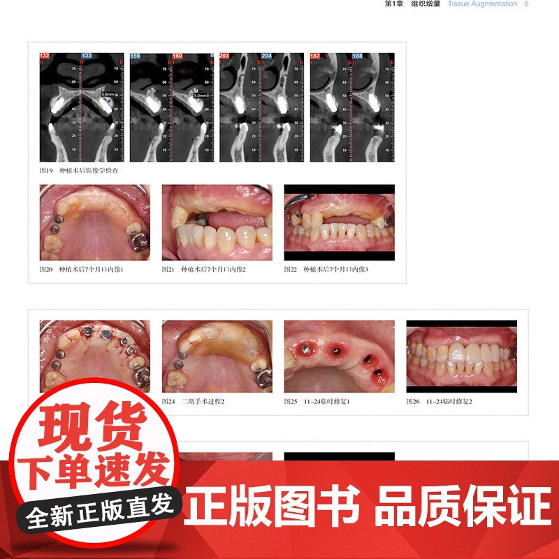 [出版社]中国口腔种植临床精萃 2025年卷 王兴 刘宝林 第13次BITC口腔种植病例大赛将获奖病例收集成册 辽宁科学高清大图