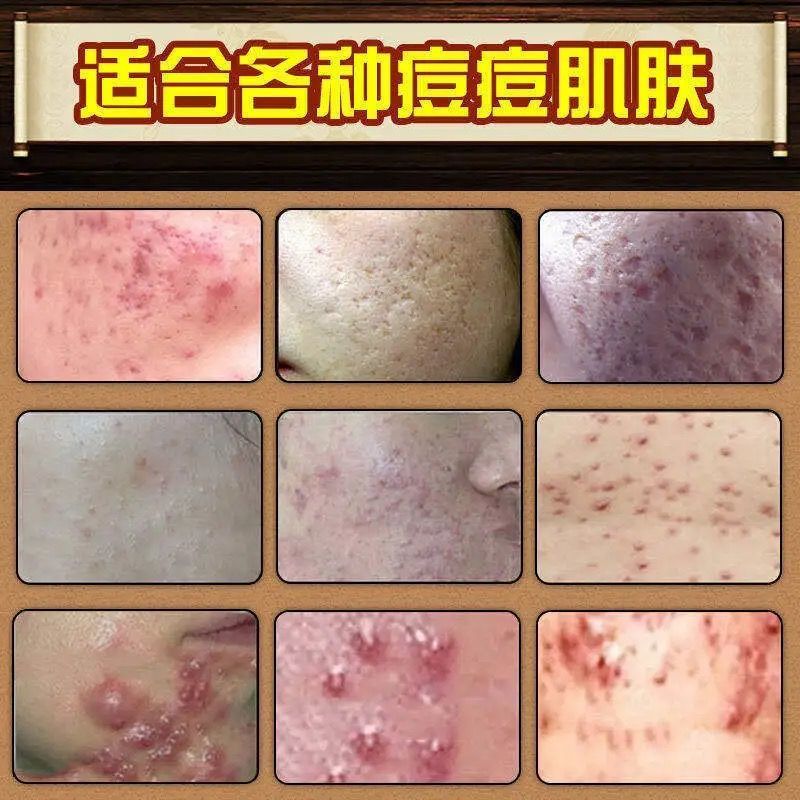 &lt;李佳琦推荐&gt;祛痘膏去痘印粉刺痘印修复男女学生祛痘疤痘坑去痘膏 一瓶装[轻度试用]