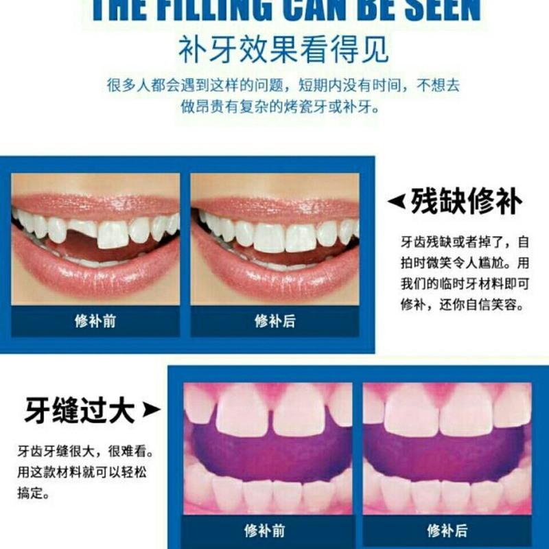 临时假牙补牙洞自己补牙齿补牙缝牙齿材料假牙材料补缺牙齿 5ml(5颗牙左右)