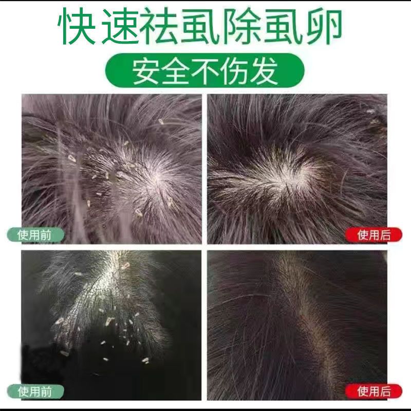 虱子药成人头部用阴虱除灭虱卵跳蚤头虱阴虱粉喷雾|三盒(买二送一)收藏产品优先发货