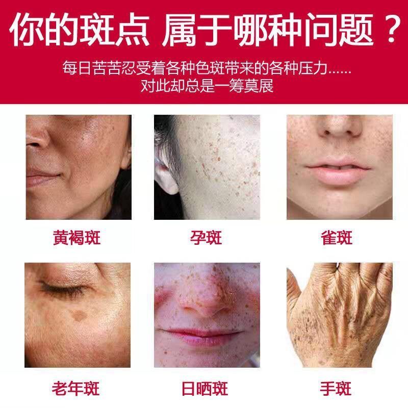 [快速祛斑]肤研美白祛斑霜淡斑提亮肤色淡化老年斑雀斑黑色素 祛斑霜1支[体验装]无