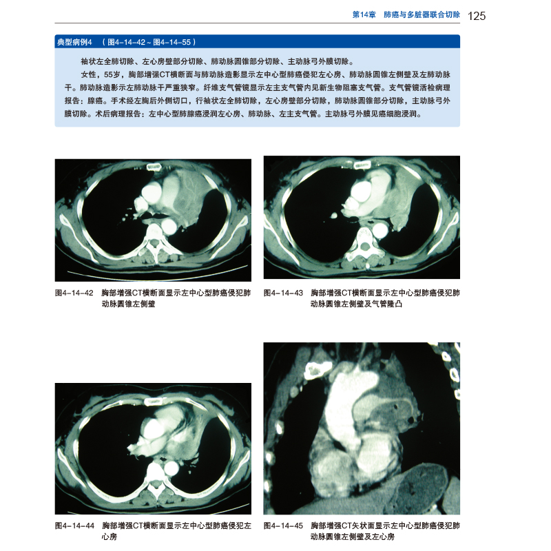 [正版]疑难胸部肿瘤手术学 许林 张勤9787571307172高清大图