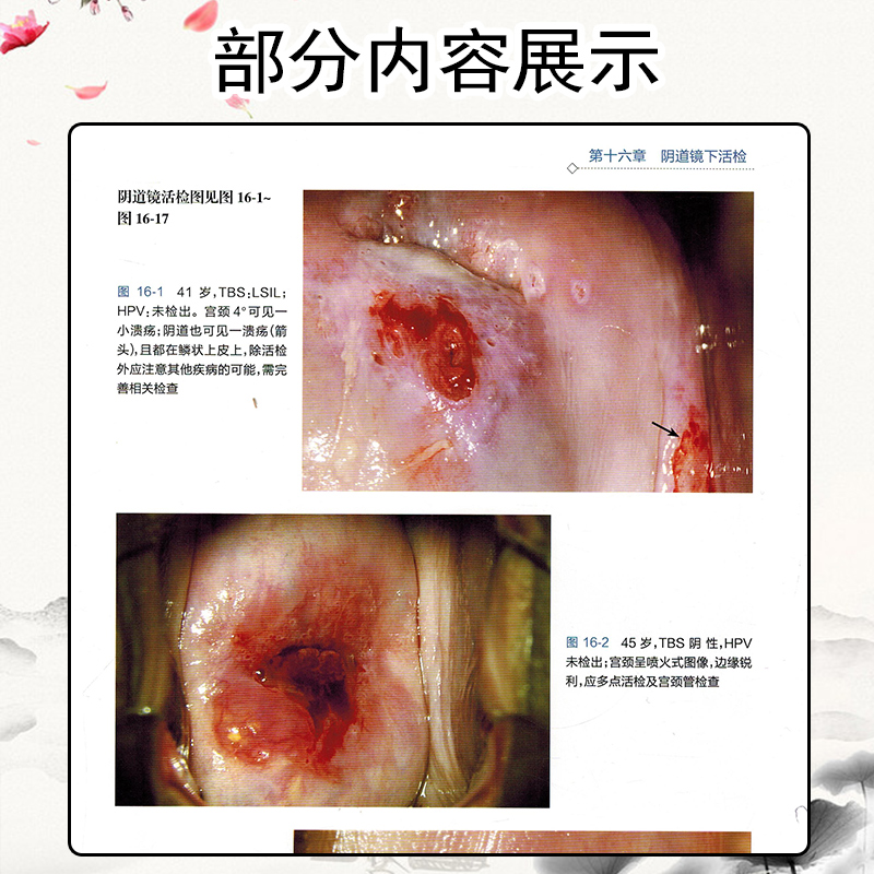[正版] 阴道镜图谱第3版第三版 主编张志胜 刘毅智 刘凤英 西医内科临床现代阴道镜学基础知识人民卫生出版社 97871高清大图