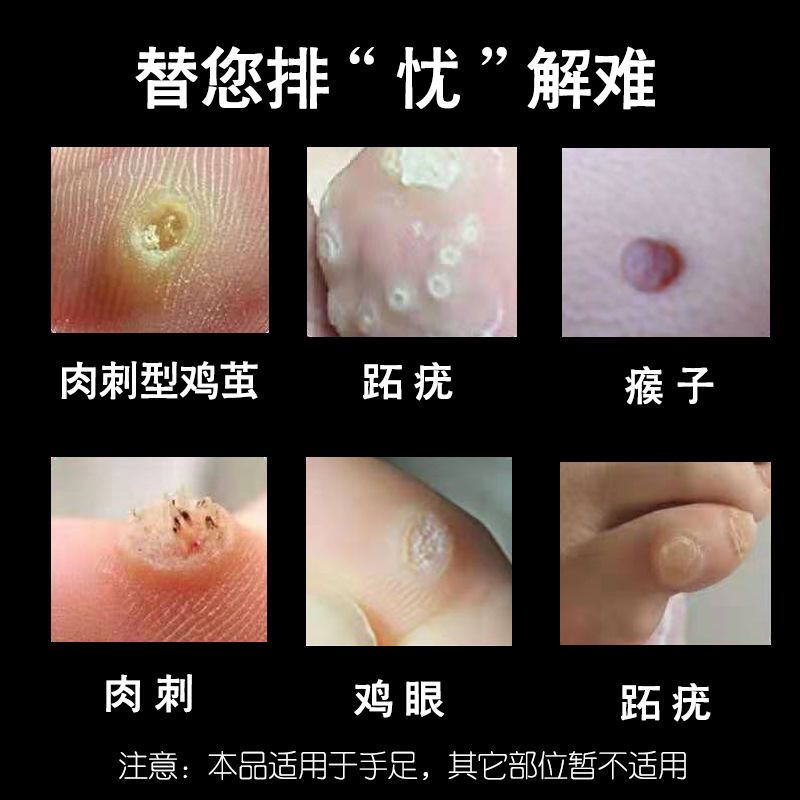茧清皮鸡眼手茧脚厚底瘊子老茧肉刺脚趾疣脚后跟开裂祛除神器