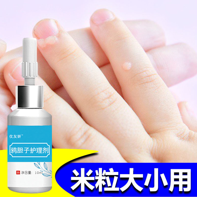 去瘊子肉粒疙瘩去脖子肉粒去腋下小猴子鸡眼刺猴跖疣丝状疣 一年以内