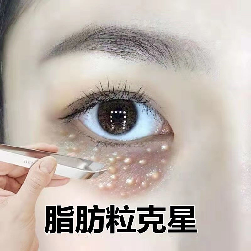 去脂肪粒汗管粒油脂粒神器眼霜祛除眼部黑眼圈脸部颗粒精华液男女 1瓶[送专业棉签]