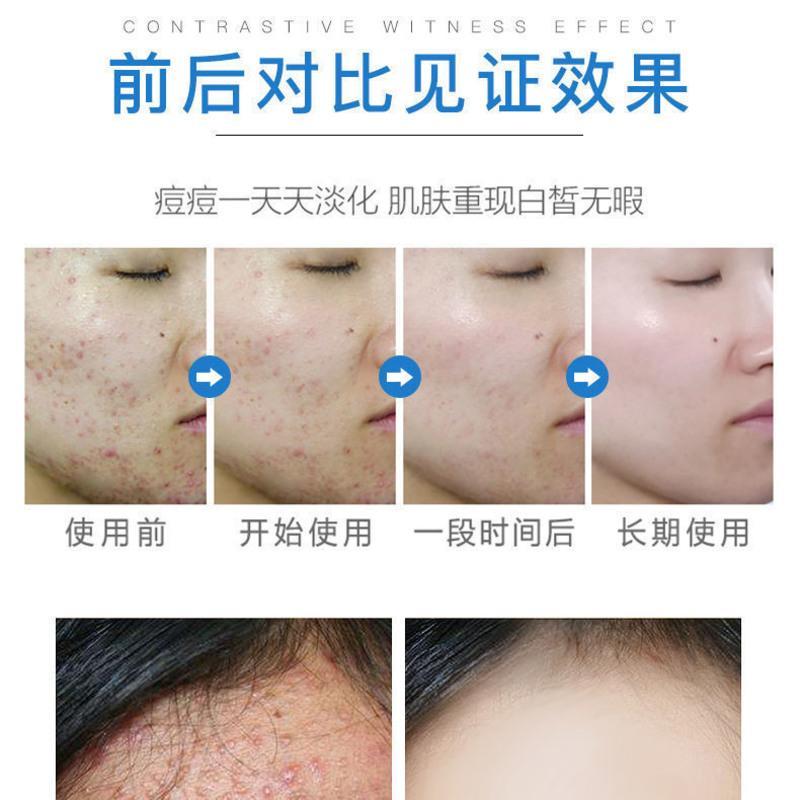 祛痘神器青春痘学生粉刺祛痘膏祛痘印痘坑修复草本无激素安全 祛痘膏1支[体验装不推荐]
