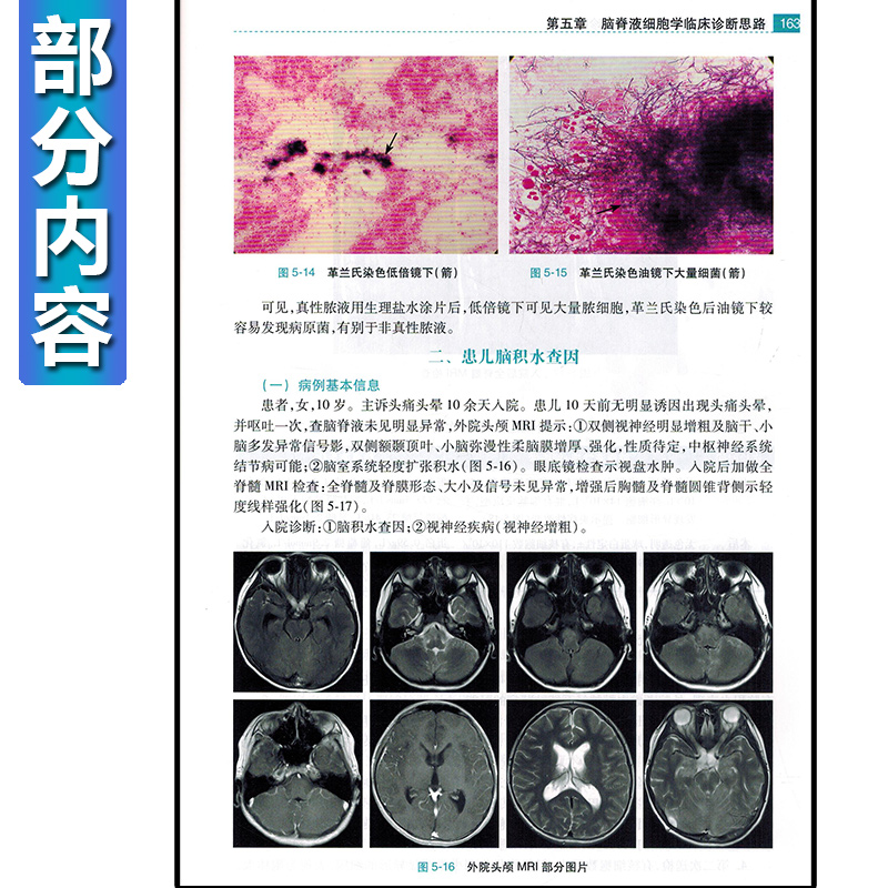 [正版] 脑脊液细胞学图谱及临床诊断思路 许绍强 主编 脑脊液细胞学内科学书籍 图谱解读和案例分析 人民卫生出版社978高清大图