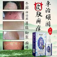 癣王牛皮癣带状疱疹神经痛用药病毒性带状疱疹外用药蛇盘疮缠腰 蛇胆疮蛇癍斑疮后遗症神经刺痛疱肤灵蜘蛛疮 雅美肤癣王喷剂【7
