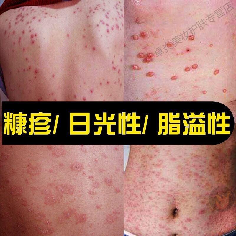 日光性皮i炎膏面部晒伤紫外线过敏晒伤修复红肿脱皮皮肤瘙痒止痒膏