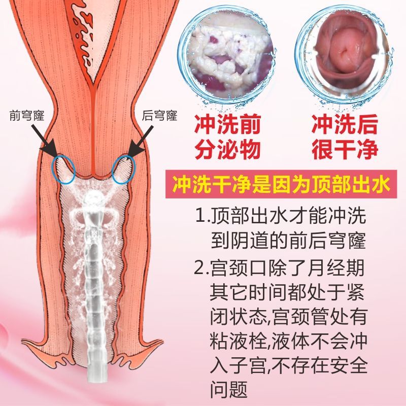 阴道清洗器私处清洁外阴阴部冲洗器重复使用内阴洁阴妇科冲洗器女 300ml冲洗器+1个冲洗头