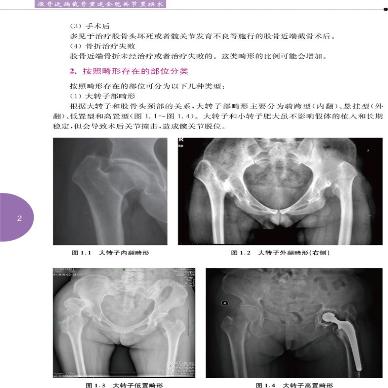 [M]股骨近端截骨重建全髋关节置换术-9787312028175高清大图